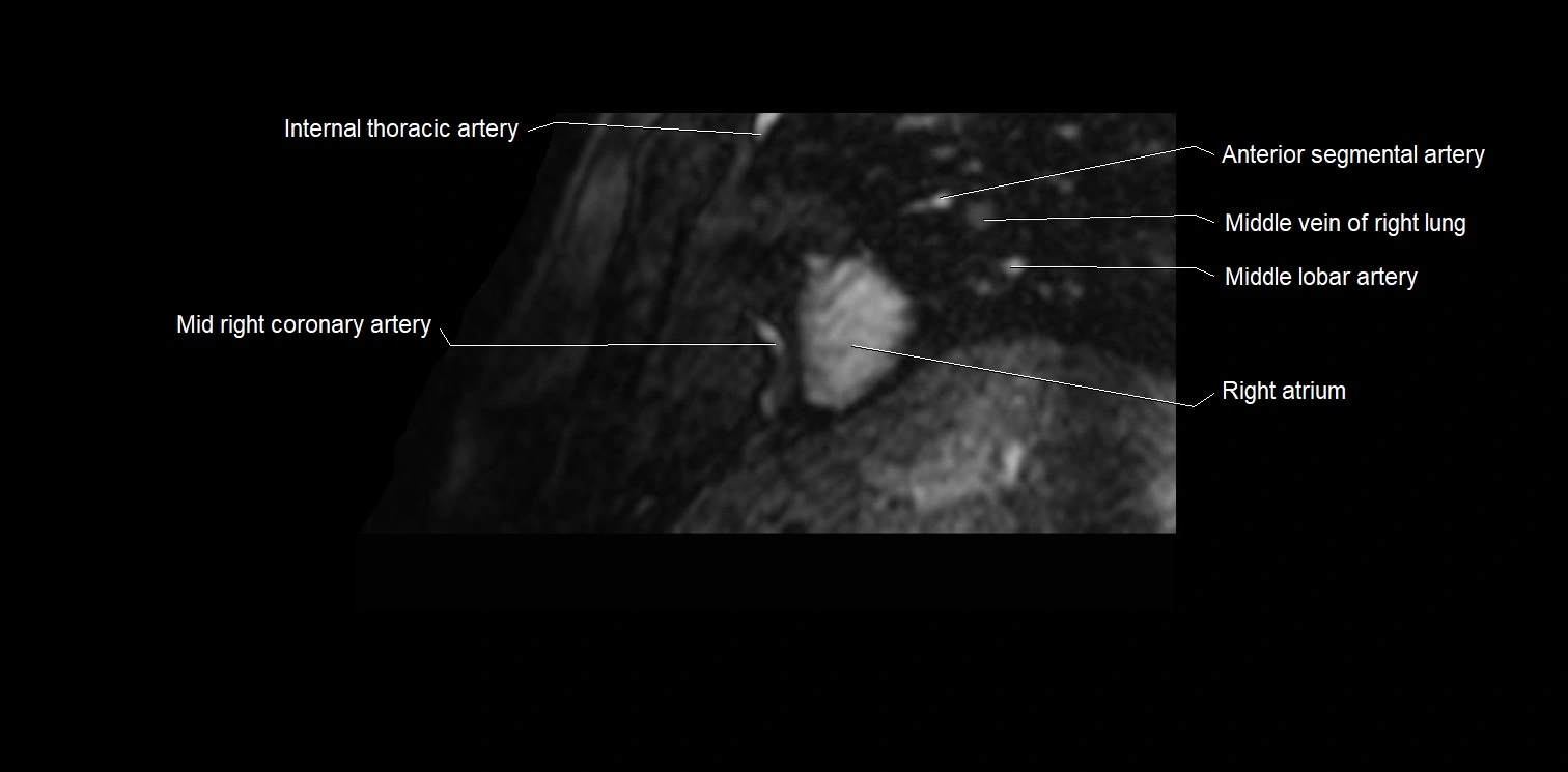 MRI heart and coronary arteries two chamber(sagittal)  anatomy image 2.webp
